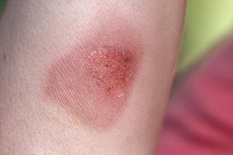 Close up of a relatively mild burn injury