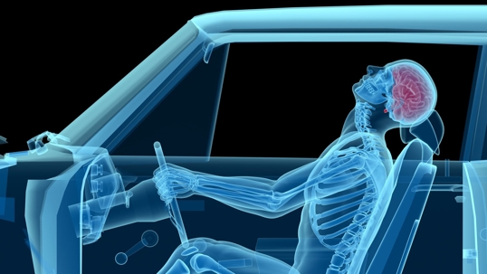 Car Crash X-Ray