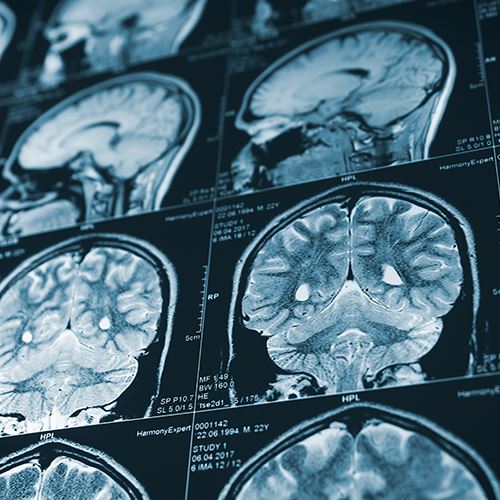 Catastrophic Injuries